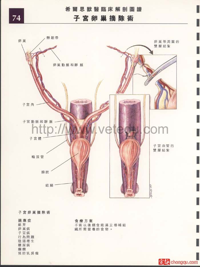 图解子宫卵巢摘除术